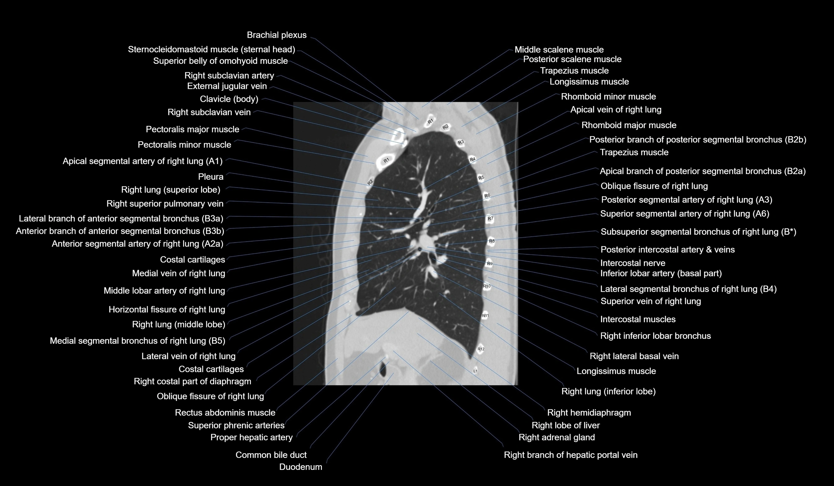 CT chest (thorax) labelled sagittal cross sectional anatomy radiology image-00056.webp